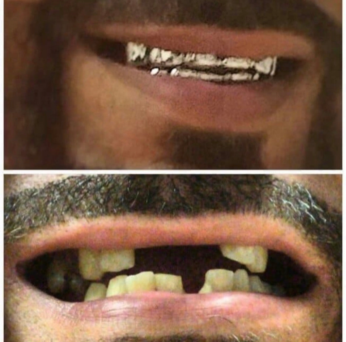 Smile Confidently with Custom Fit Grillz: A Quick and Affordable Solut ...