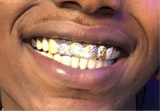 Two Tone Grillz